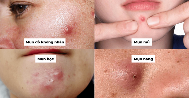 Các loại mụn viêm