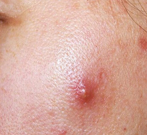 Phương pháp kiểm soát mụn bọc