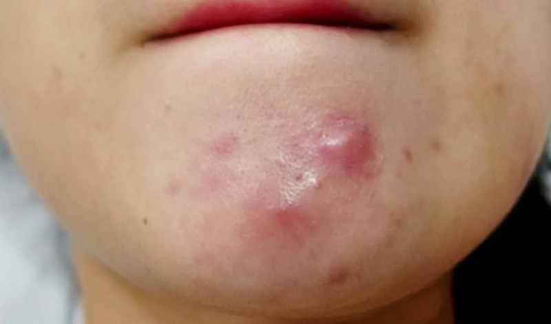 Mụn bọc trên cằm