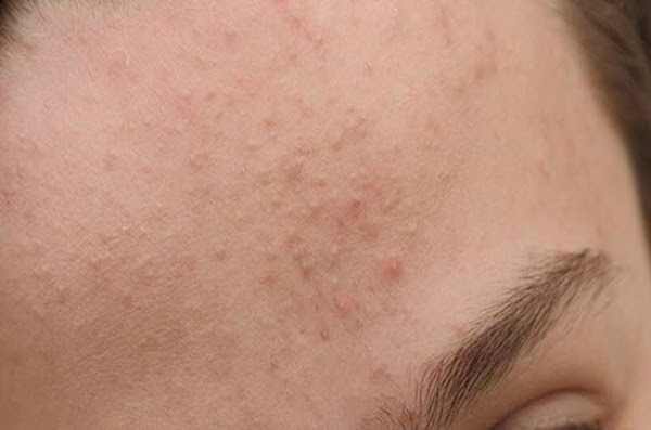 Mụn ẩn là gì? cách điều trị mụn ẩn