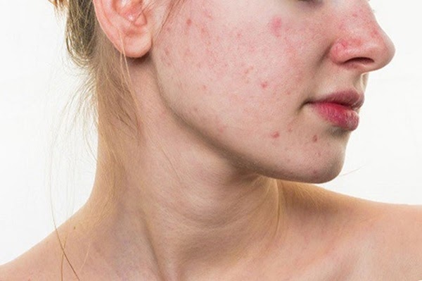 Yếu tố của mụn trứng cá cũng chính là yếu tố gây ra mụn ẩn