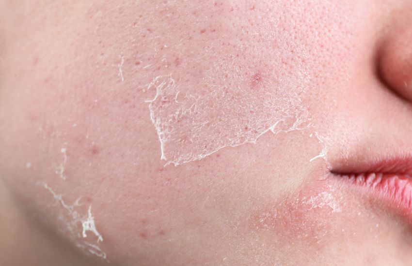 Hiện tượng sau peel da