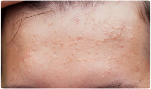 Mụn đầu trắng là gì?