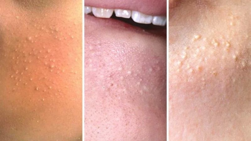 Dấu hiệu nhận biết mụn trứng cá