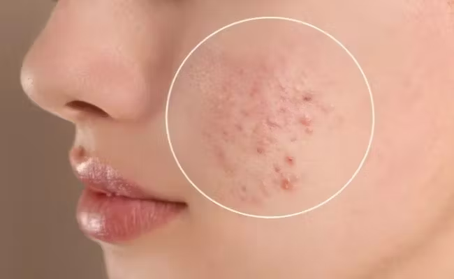 Mụn là gì? Nguyên nhân hình thành mụn
