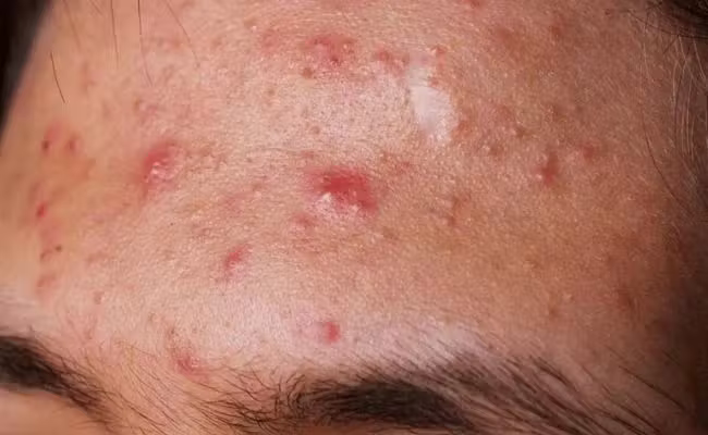 Mụn viêm đỏ