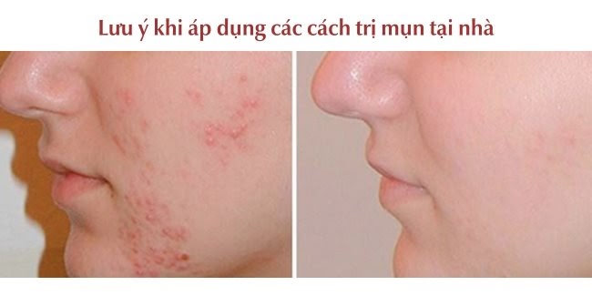 lưu ý khi trị mụn tại nhà