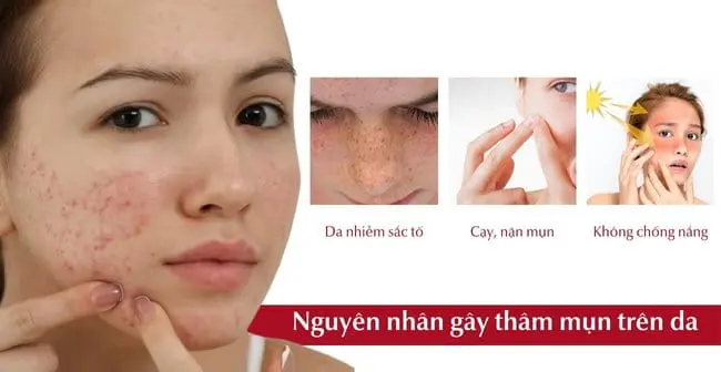Nguyên nhân gây thâm mụn