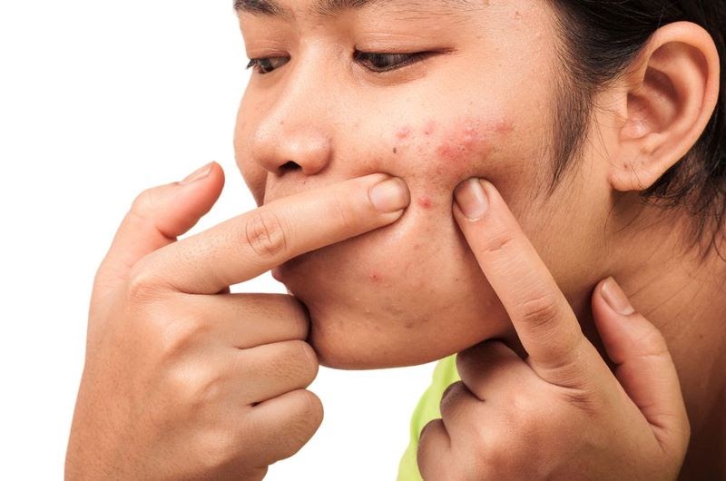 Nặn mụn có tốt không?