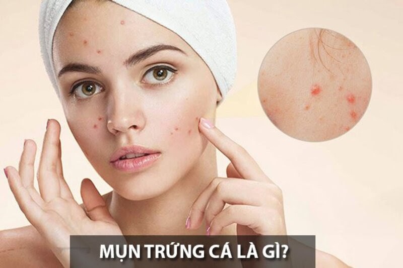 Mụn trứng cá là gì