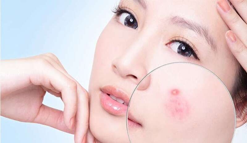 Điều trị mụn trứng cá cấp độ nhẹ