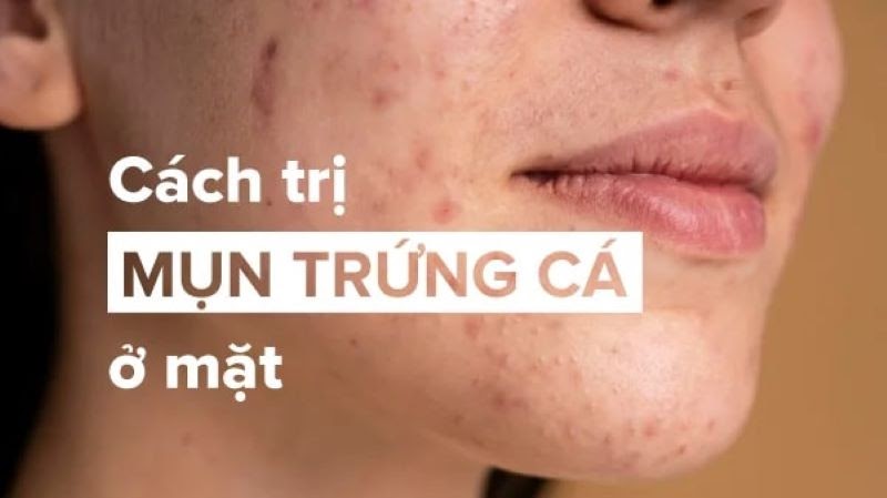 Cách trị mụn trứng cá