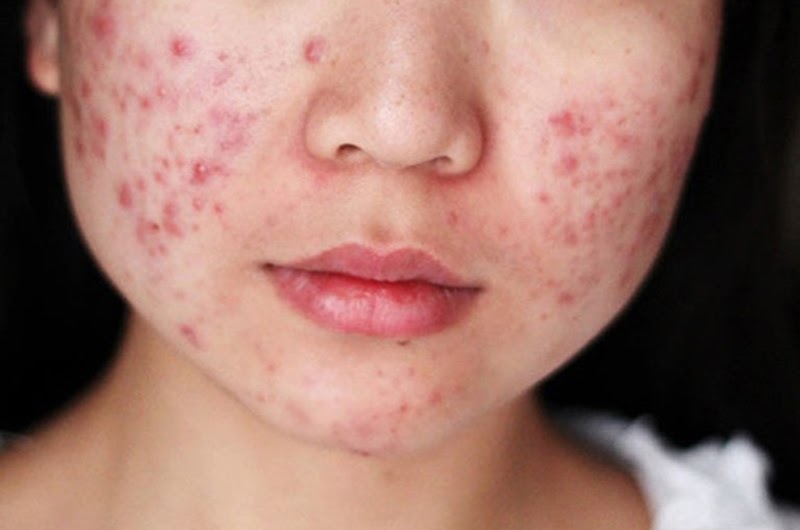 Nguyên nhân gây ra mụn trứng cá