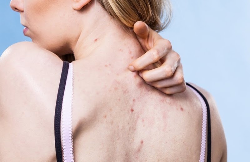 Nguyên nhân gây mụn trứng cá ở lưng