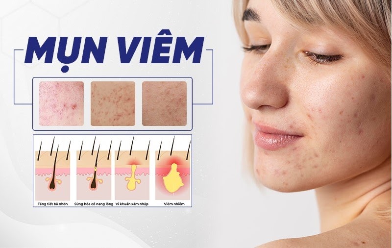 Mụn viêm là gì