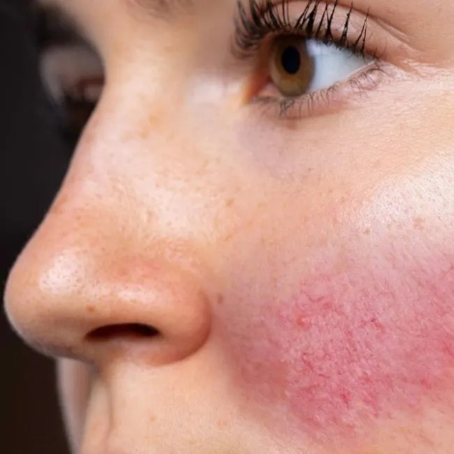 HIện tượng sau khi peel da bị đỏ